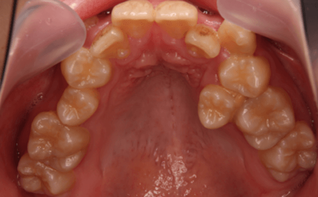 矯正治療開始前の画像