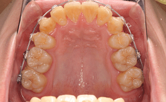矯正治療終了時の画像
