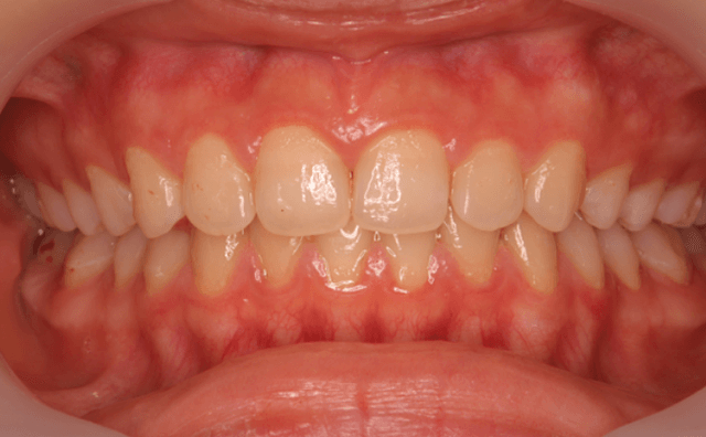 矯正治療終了時の画像