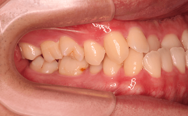 矯正治療開始時の画像