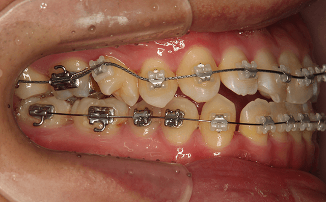 ワイヤ－矯正中の画像