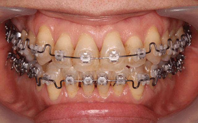 非抜歯矯正治療終了時