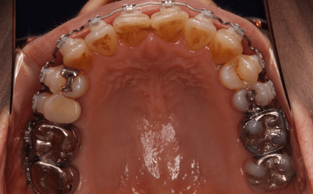 非抜歯矯正治療終了時