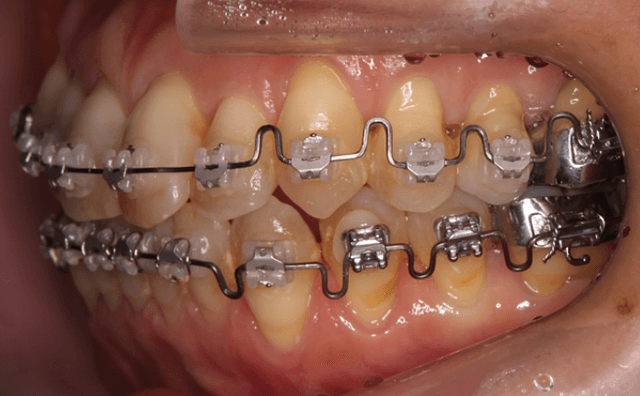 非抜歯矯正治療終了時