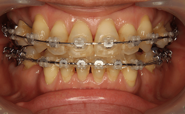 上下4番抜歯矯正治療開始時