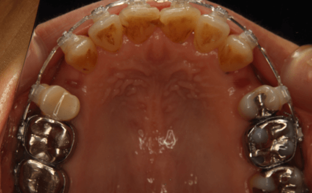 上下4番抜歯矯正治療開始時