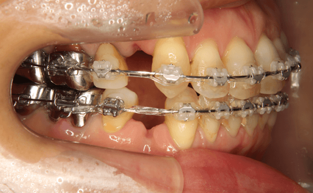 上下4番抜歯矯正治療開始時