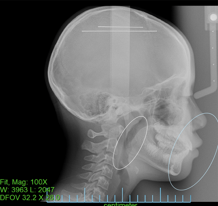 矯正治療後のセファロ画像