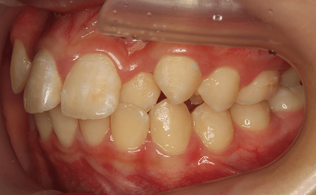 初診時の口腔画像