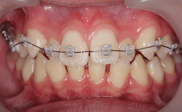 ワイヤ－矯正開始時の口腔画像