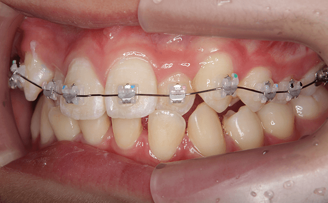 ワイヤ－矯正開始時の口腔画像