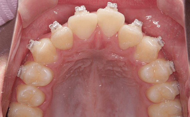 ワイヤ－矯正ほぼ終了時の口腔画像