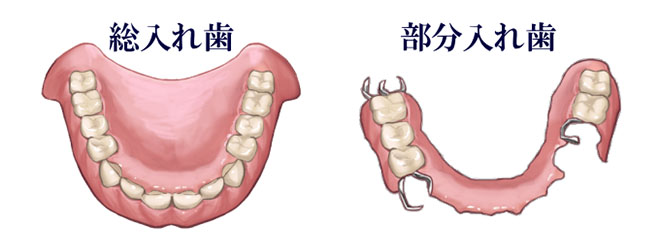 総入れ歯・部分入れ歯