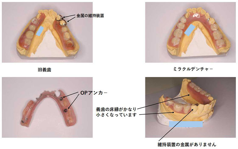 保険のデンチャーとミラクルデンチャー