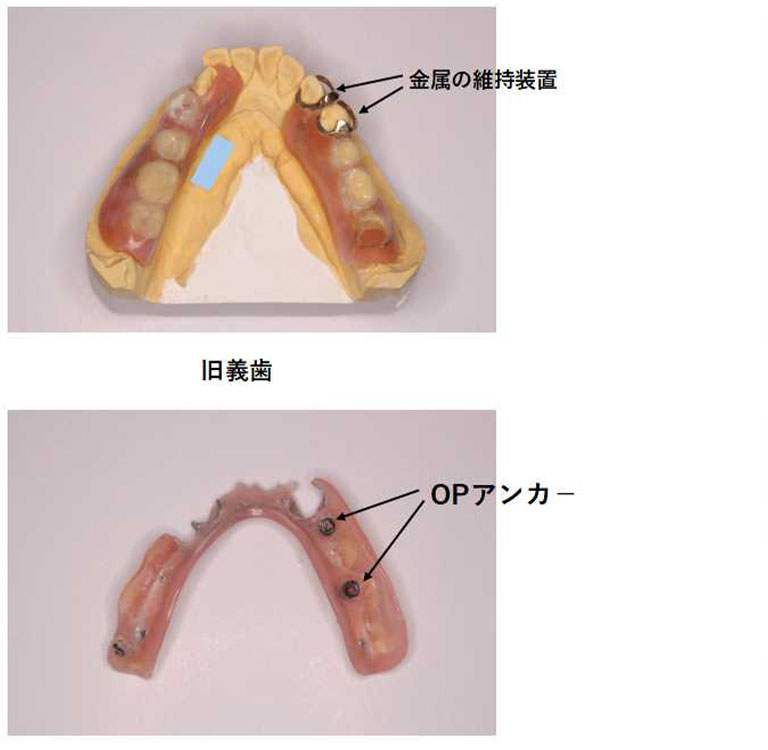 保険のデンチャーとミラクルデンチャー