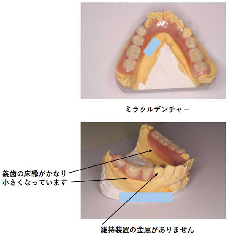 保険のデンチャーとミラクルデンチャー