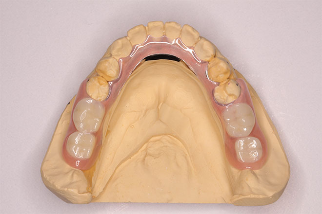 下顎の義歯