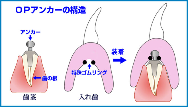 根面アタッチメント