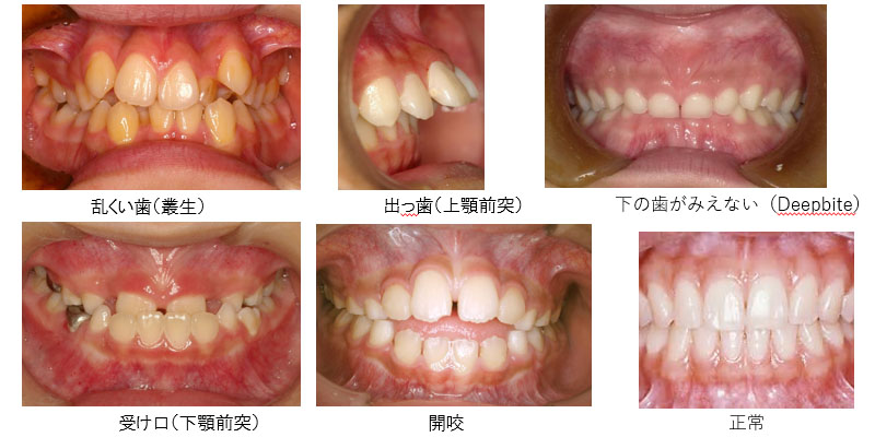 不正咬合の種類