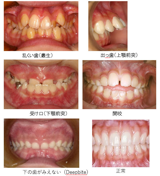 不正咬合の種類