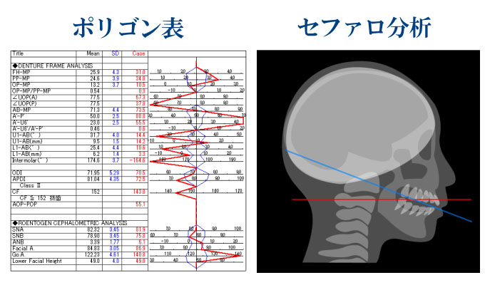 ポリゴン表・セファロ分析