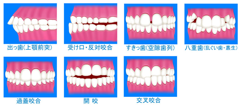 矯正治療が可能な歯並び