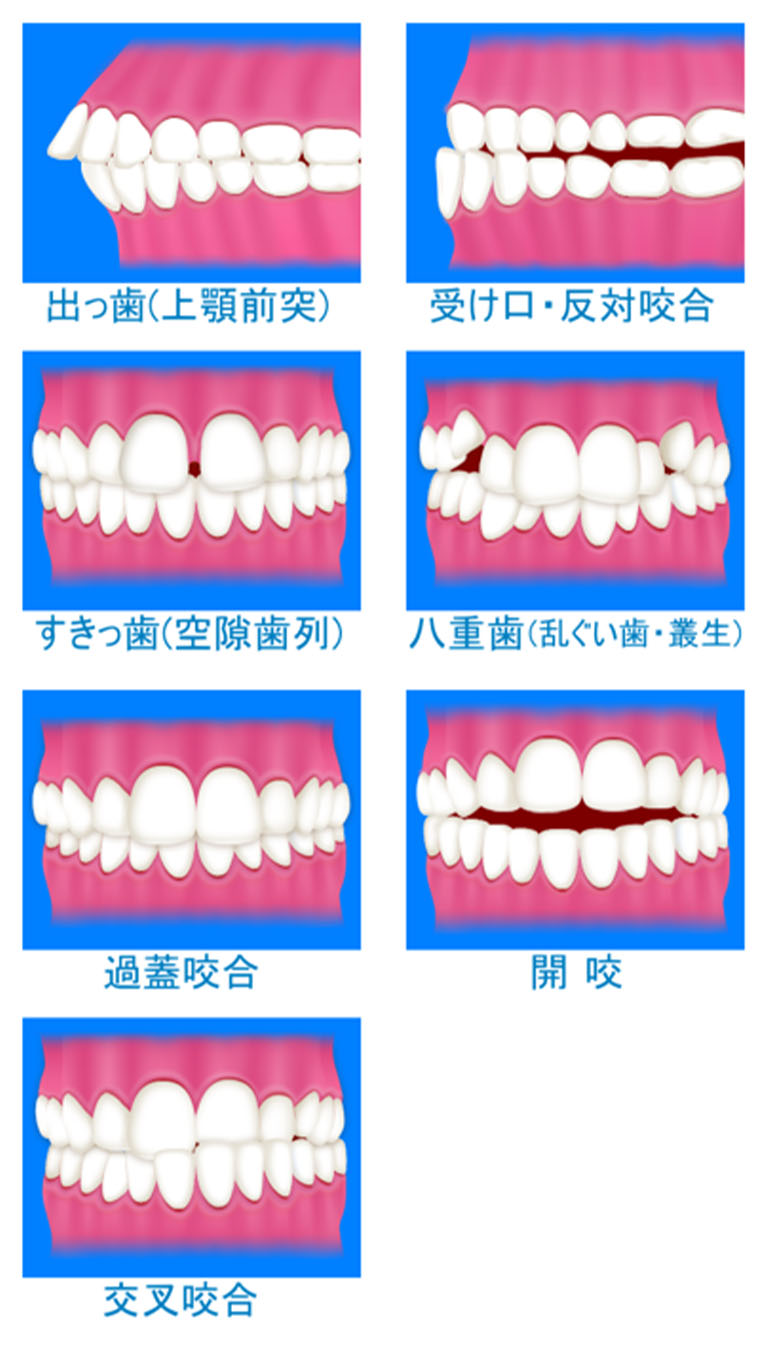 矯正治療が可能な歯並び