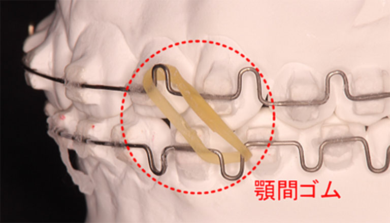 矯正装置に顎間ゴムを装着した状態