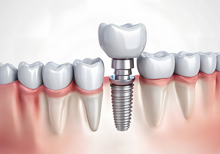 しっかり噛める喜びを、インプラントで取り戻す